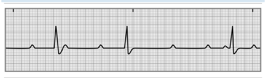 <p>is a complete block of electrical conduction between the atria and ventricles, leading to a dissociation between the atrial and ventricular contractions. This can be observed on an EKG with independent P waves and QRS complexes. </p>