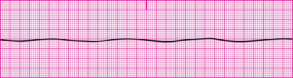 <p>Absence of ventricular activity and depolarization; no electrical activity is present in the myocardium; straight line/ flatline; Always confirm waveform in at least two different leads to rule out “fine” ventricular fibrillation.</p><p></p><p>Rhythm: No waveforms are present.</p><p>Rate: No atrial or ventricular rates are present.</p><p>P wave morphology: No P waves are present.</p><p>PR interval: Cannot be measured</p><p>QRS duration and morphology: Not measurable</p><p></p><p>Situation is life-threatening.</p><p>Patient will be unconsciousness and apneic.</p><p>Patient is in cardiac arrest; initiate emergency procedures.</p><p>Always a Code Blue situation.</p>