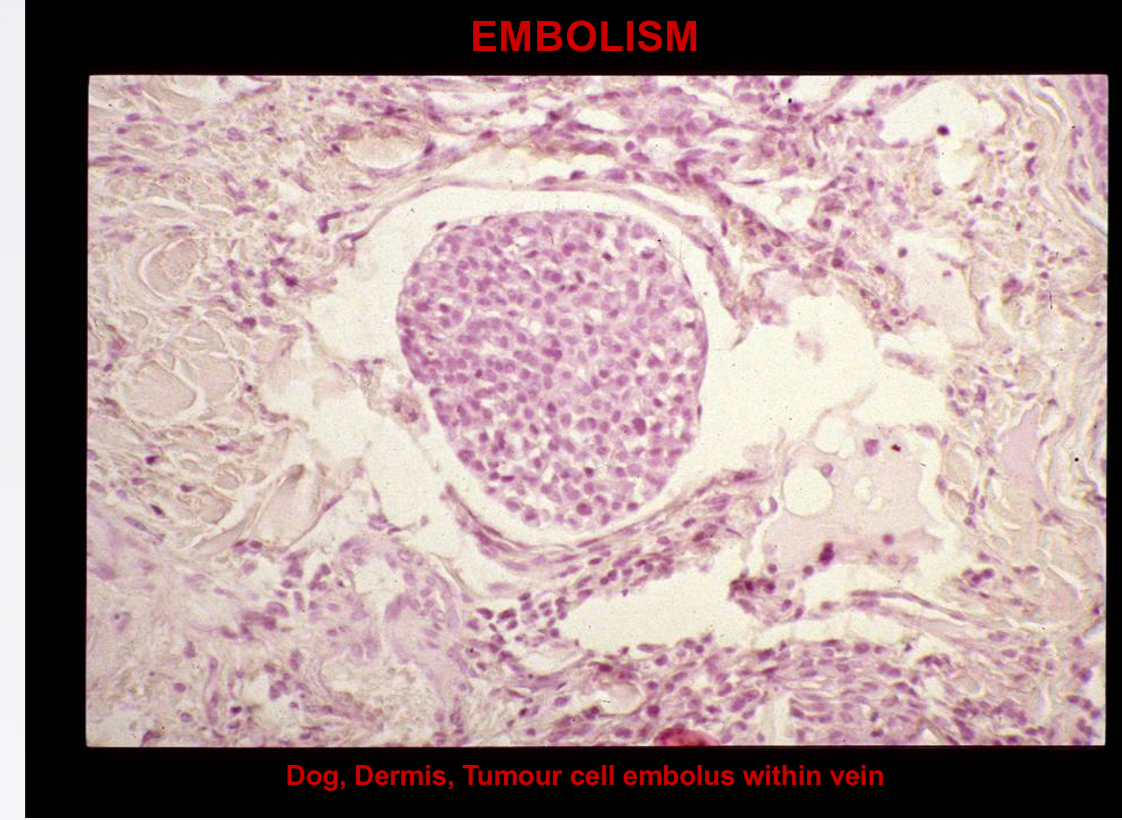 <p>Term for tumour cell embolus production </p>