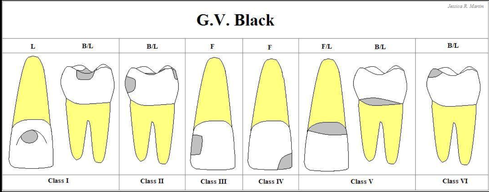 <p>Class 1: Pits and Fissures</p><p>Class 2: Proximal surfaces of posterior teeth</p><p>Class 3: Proximal surfaces of anterior teeth</p><p>Class 4: Proximal surfaces of anterior involving incisal edge</p><p>Class 5: Gingival 3rd of facial or lingual surface of all teeth</p><p>Class 6: Involving cusp tips</p>