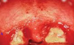 <p><strong>Etiology of Pharyngitis/Tonsilitis</strong></p><p>-Most common cause are __________, followed by group A beta hemolytic strep (Strep Pyogenes)</p><p>-Mycoplasma</p><p>-STDs like __________ and ________ can also cause pharyngitis/tonsilitis </p>