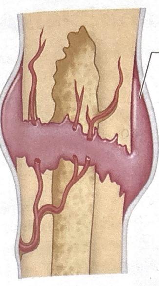 <p>first stage of bone fracture healing</p>