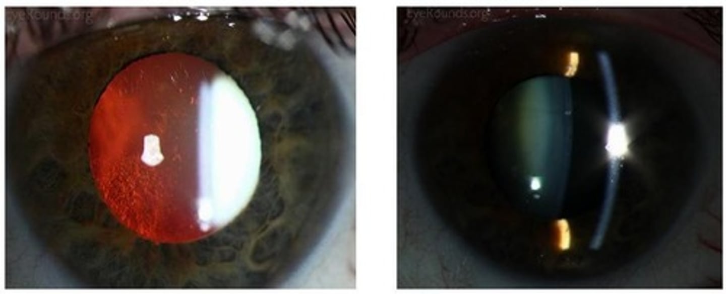 <p>A diagnostic technique used to visualize cataracts by shining light through the lens.</p>