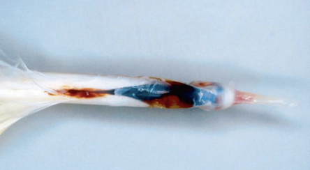 <p>Which form of PBFD occurs with gradual loss of plumage bilaterally, along with dystrophic feathers (short, retained sheath, bloody), secondary infections, and difficulties in eating, leading to hypoproteinemia, weight loss, and death?</p>