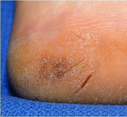 <p>linear crack from epidermis to dermis; ex- cheilitis, athletes foot</p>