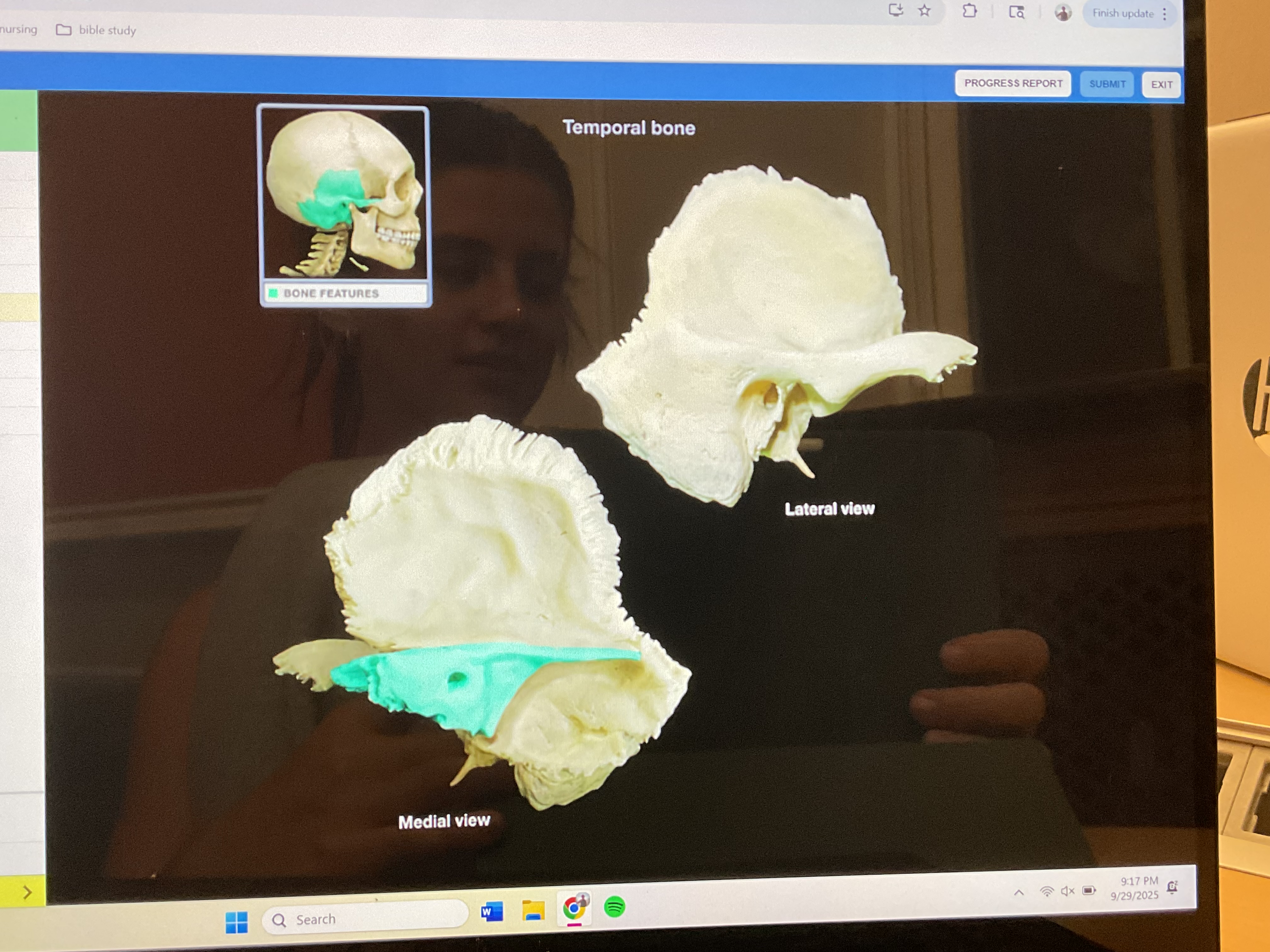 <p>Petrous part of temporal bone </p>