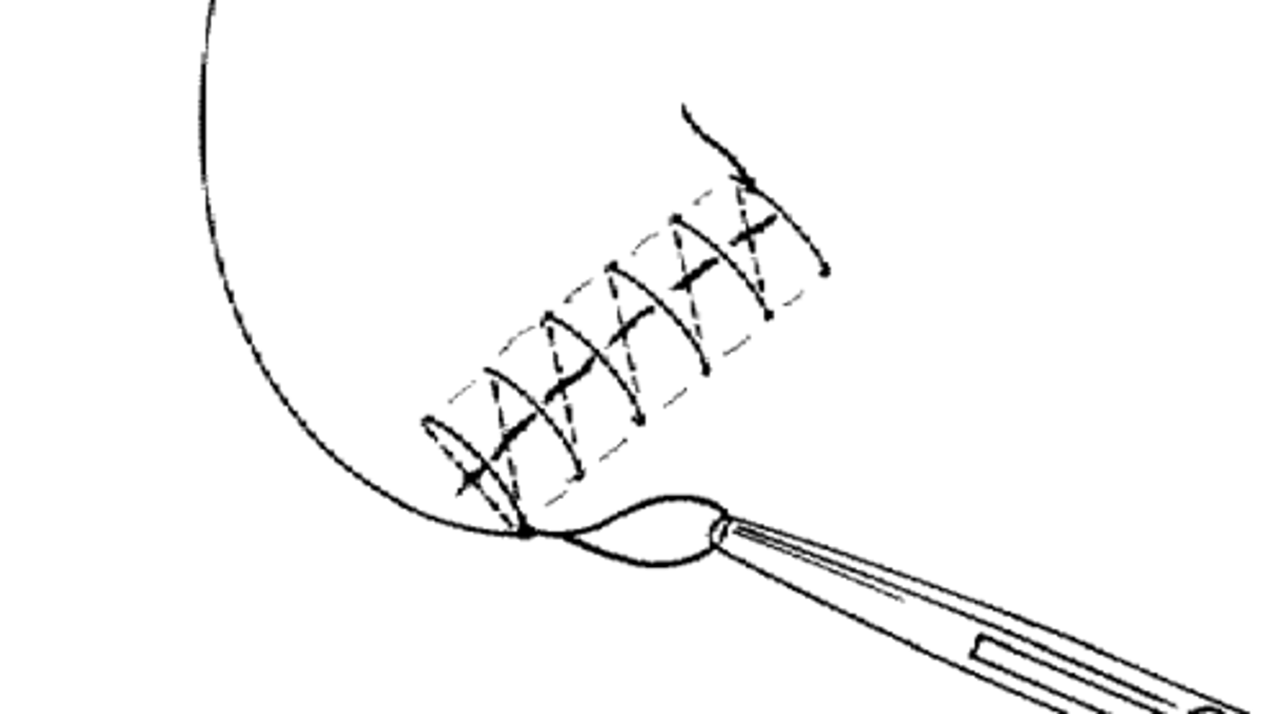 <p>-series of stitches made without tying each knot creating a single running sitch.</p><p>-Quick, less secure</p><p>-Shouldn't be used in areas of existing tension. Not possible to free a few sutures at a time. When one suture breaks it affects the whole closure.</p>