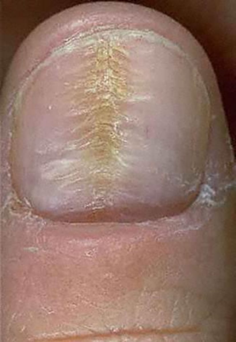 <p>Depression of central nail resulting from repetitive trauma, "Christmas tree" appearance</p>