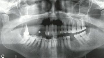 <p>soft tissue mass with destuction of bone </p>
