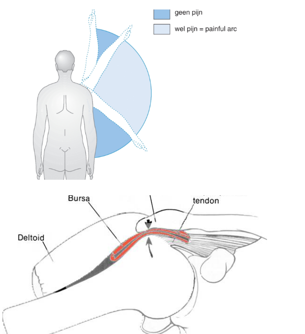 <p>Het subacromiaal pijnsyndroom: pijnklachten in de schouder rond deltoideusregio.</p><p>pijn neemt snachts toe en bij bewegen boven schouder niveau.Unilateraal.</p><p><strong><mark data-color="#fafc94" style="background-color: rgb(250, 252, 148); color: inherit;">Painful arc</mark></strong><mark data-color="#fafc94" style="background-color: rgb(250, 252, 148); color: inherit;">: tijdens een deel van de bewegingen doet het pijn, namelijk abductie tussen 60-130 graden. Overige deel is pijnvrij.</mark></p><p>Bij painful arc ontstaat er compressie van de supra of insraspinatuspees, impingement. Dit kan leiden tot cuff degeneratie. Scapulohumerale ritme is verstoord.</p><p>→ Behandeling= trainen van schouderdepressoren, activiteit afbouwen en soms corticosteroid injecties.</p>