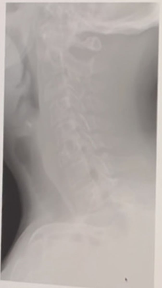 <p>Name sign seen above:</p><p>Vertebra plana</p><p>Rugger jersey spine</p><p>Corduroy cloth</p><p>Picture frame vertebra</p>