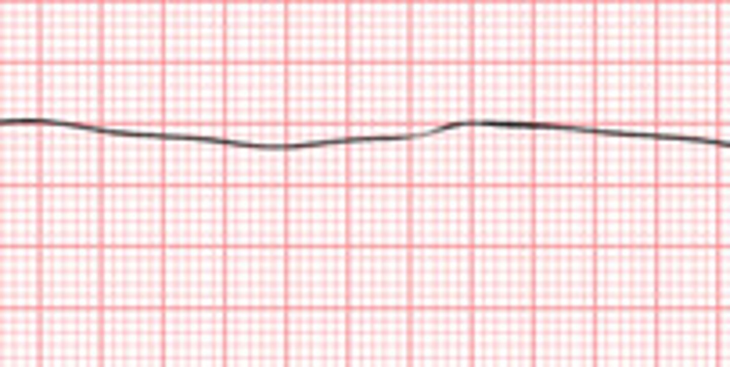 <p>complete absence of ventricular electrical activity in the heart. no ventricular contraction occurs<br>client is pulseless, apneic, and unresponsive</p>