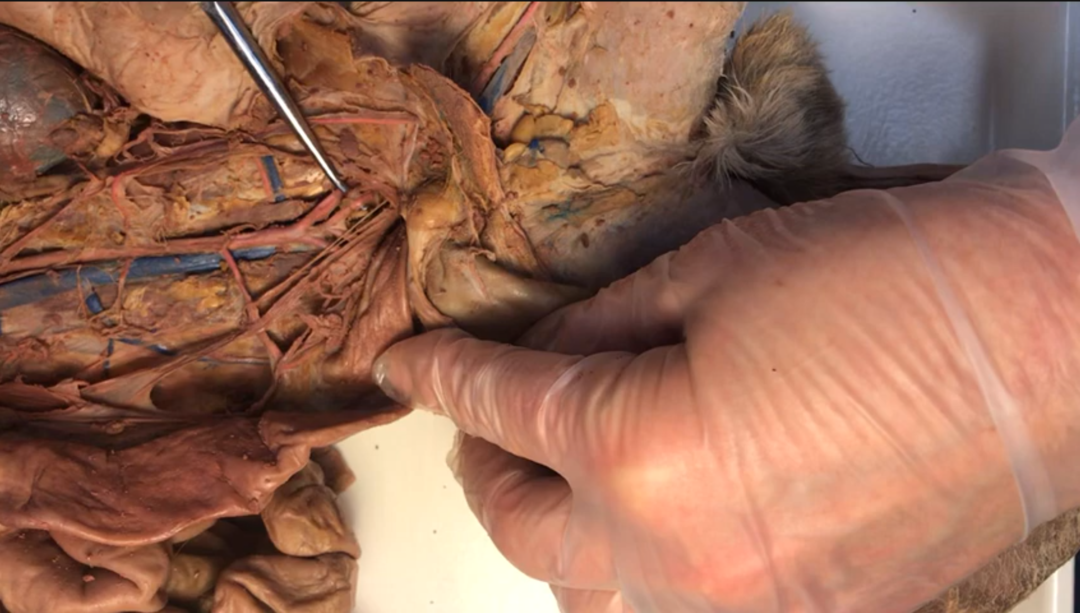 <p>What artery is this</p>