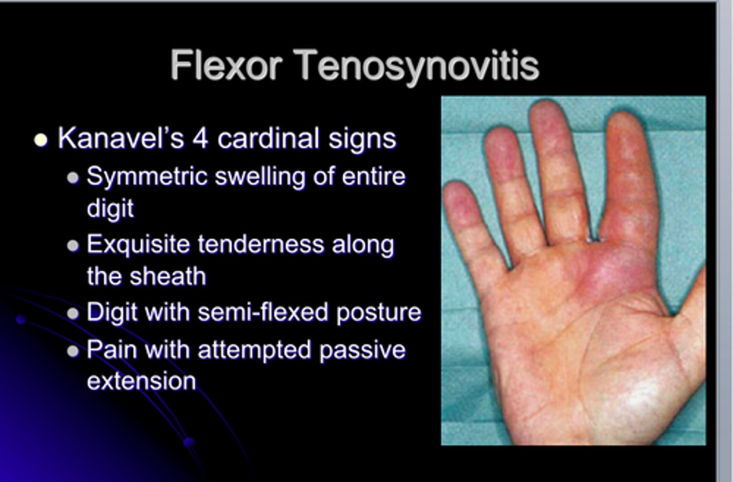 <p>-inflammation of the tendon and synovial sheath that causes the finger to swell and become painful to move on the volar side</p><p>-S&amp;S: heat, swelling, pain or tenderness over the tendon sheath</p><p>evaluate</p><p>-evaluate the digits between MCP and PIP</p><p>-gently pull all digits into hyperextension at MCPs at one time to test simultaneously</p><p>-describe location and what motion, if any, increases pain</p>