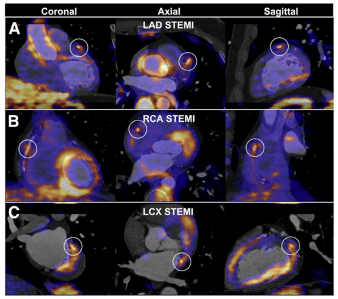<p>above 50%. angiogram may be indicated if EF , 35%</p>