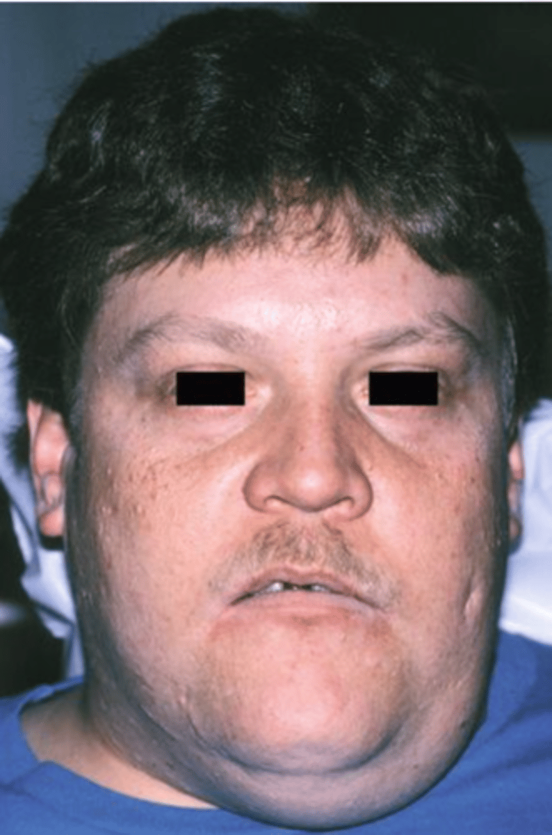 <p>Resembles frogs</p><p>underbelly, Less common type of mucocele</p>
