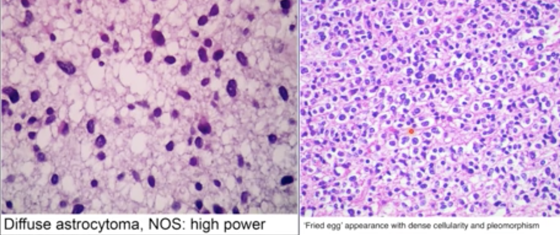 <ul><li><p>They are very infiltrative and impossible to remove completely via surgery</p></li><li><p>They never metastasise outside the CNS</p></li><li><p>Presence/ Number of mitosis, Endothelial proliferation, Necrosis are all useful for prognosis grading</p></li><li><p>Highest grade (WHO IV) → survival of only 1 year</p></li></ul>