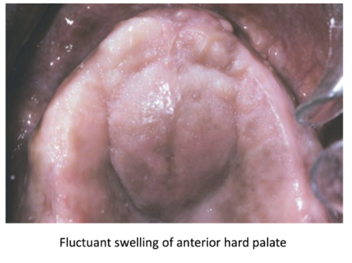 <p>incisive papilla (or nasopalatine duct cyst)</p>