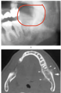<p>Osteosarcoma </p>