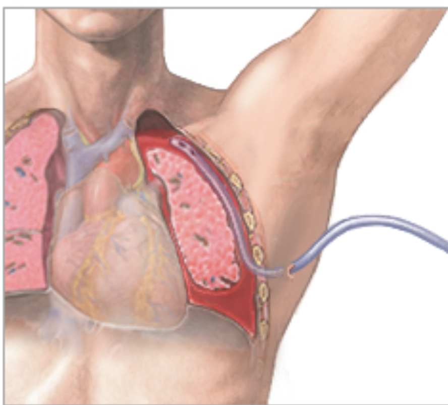 <p>hemothorax chest tube</p>