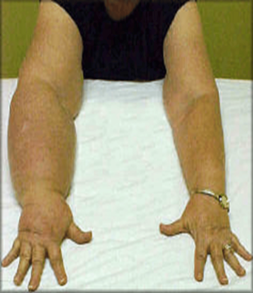<p>Abnormal collection of protein-rich fluid in the intrstitium due to obstruction of lymphatic drainage, resulting in painful swelling.</p><p>Primary causes (genetics)</p><p>Secondary causes (surgery, radiotherapy or infection)</p><p>Removal of nodes can lead to lymphoedema of a limb</p>