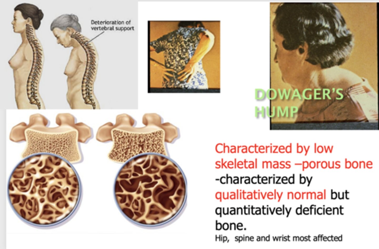 <p>Osteoporosis</p>