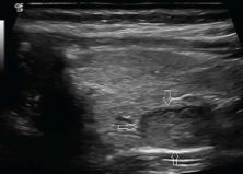 <p>A 65-year-old woman presents with fatigue and mild bone pain. Laboratory tests reveal elevated serum calcium and elevated parathyroid hormone (PTH) levels. Based on the clinical presentation and ultrasound image, what is the most likely diagnosis?</p>