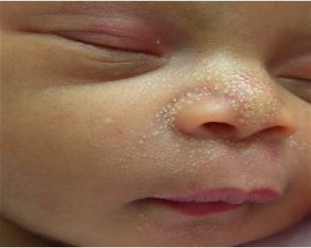 <p><strong>What are white papules w/o erythema to the nose, chin, &amp; forehead that are caused by retained sebum?</strong></p>