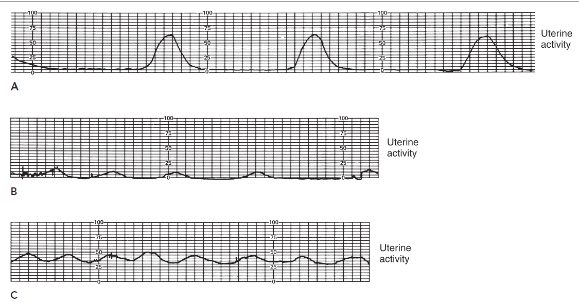 <p>Which among here is the normal uterine activity?</p>