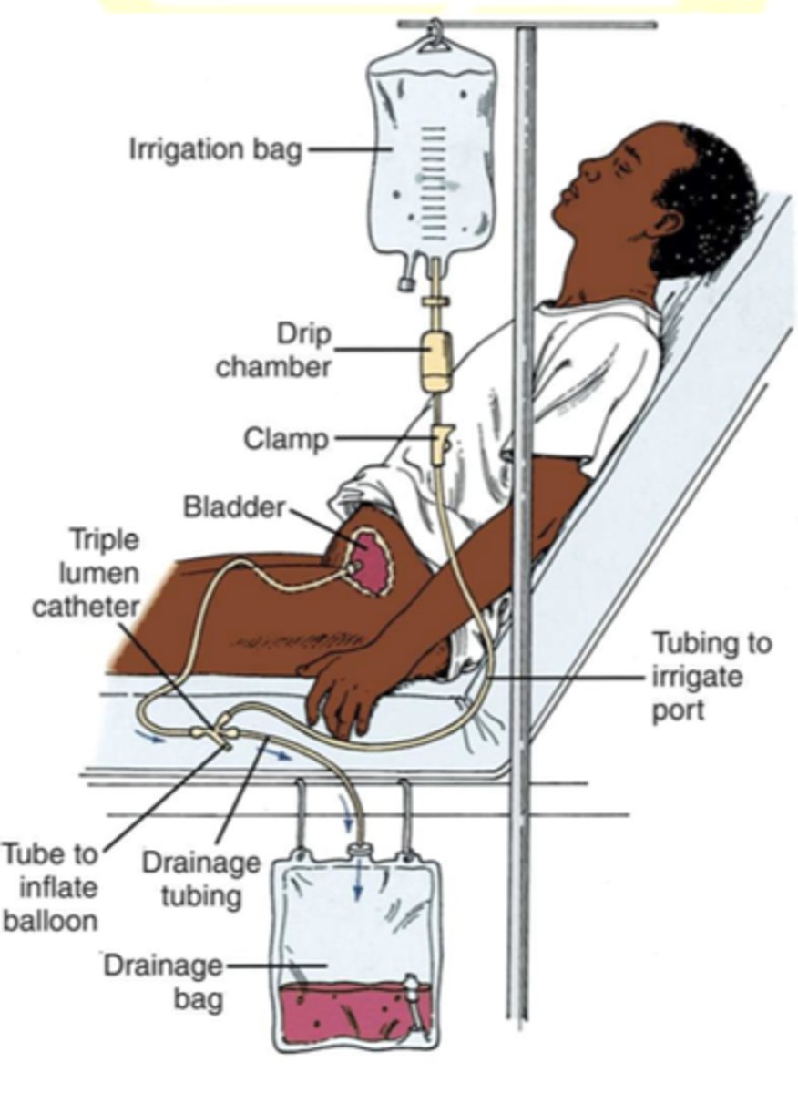 <p><strong>Cystoclysis</strong></p><p>This process aims to manage various conditions by maintaining bladder hygiene and ensuring the free flow of urine.</p>