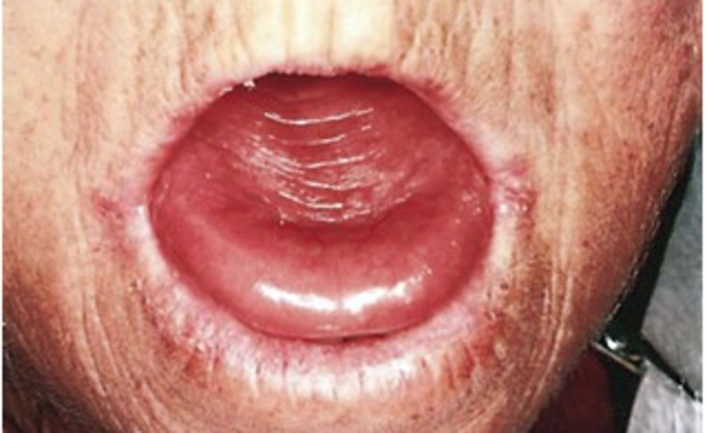 <p>-stomatitis</p><p>-glossitis</p><p>-red and smooth tongue</p>