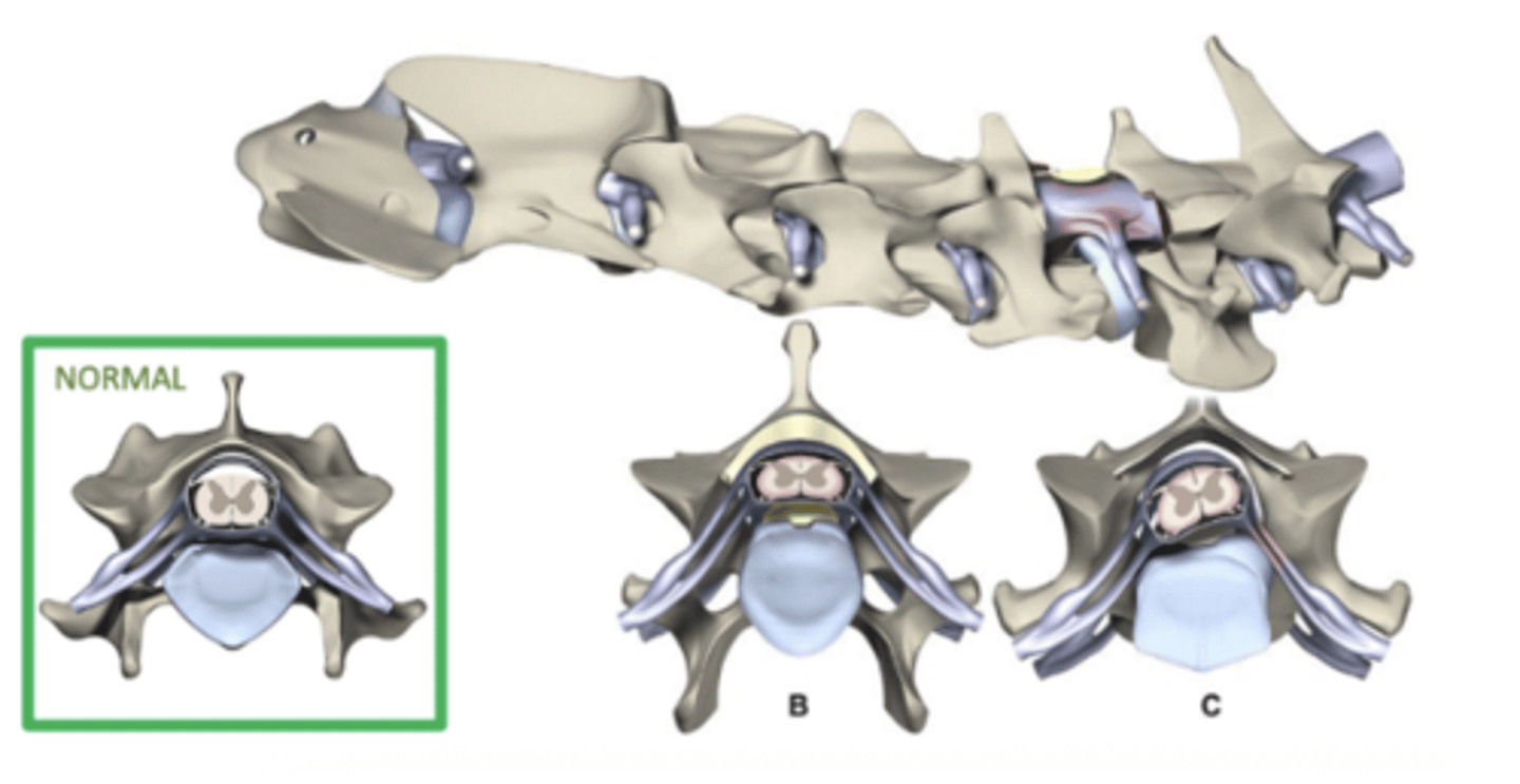 <p>- Instability of caudal cervical vertebrae and Disc starts to bulge (chicken and the egg with past two) -> Vertebrae subluxate past each other as patient move -> Frequent micropressure on disc -> Disc bulging -> Spinal cord compression -> Ataxia</p>