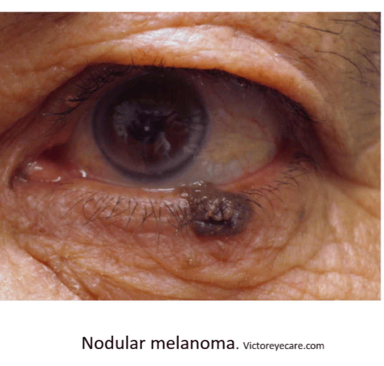 <p>dark to amelanotic nodule with rapid growth, tendency to ulcer and bleed</p>