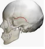 <p>parietal and temporal suture</p>