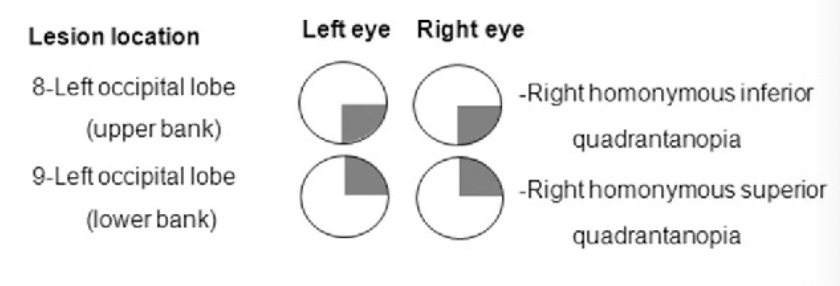 <p>occipital lobe optic radiations lesion </p><p>“pizza on the floor” anopia, “pie in the sky” anopia, put together: homonymous hemianopia </p>