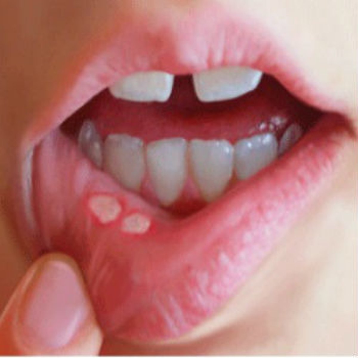 <p><b>Secondary</b> <br><br>non-scarring wearing away of the superficial epidermis; surface is moist but does <b>not</b> bleed<br><br>example: aphthous stomatitis</p>