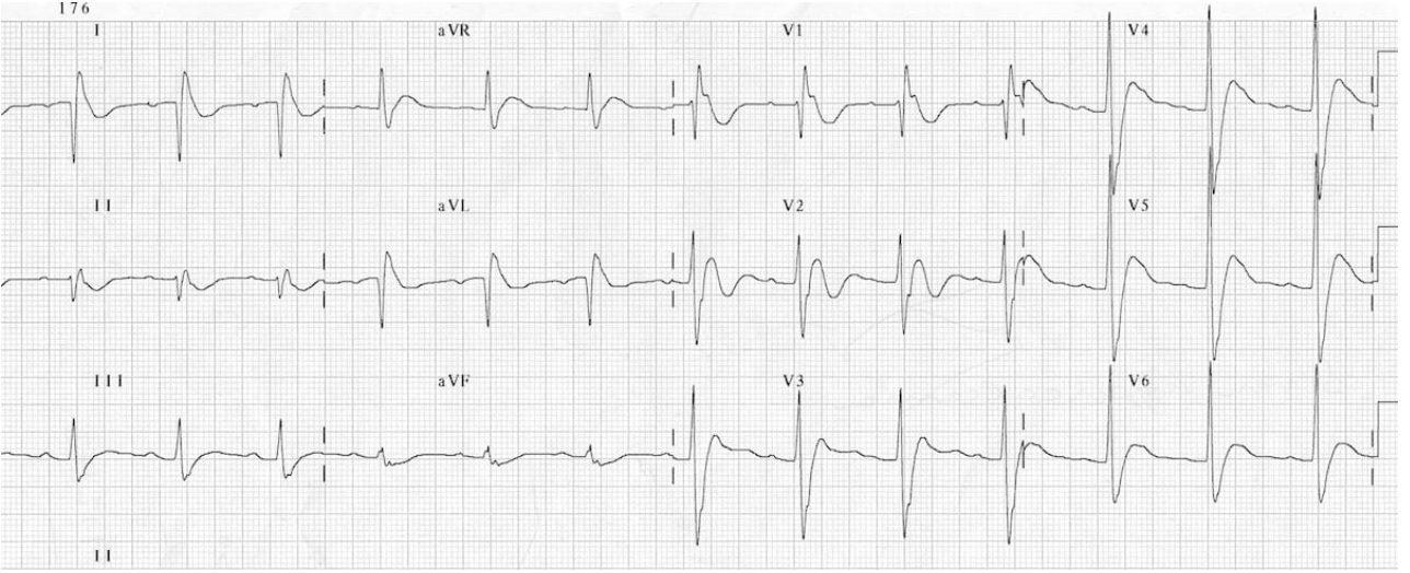 <p>Cardiovascular symptoms of hyperparathyroidism - hypercalcemia</p>