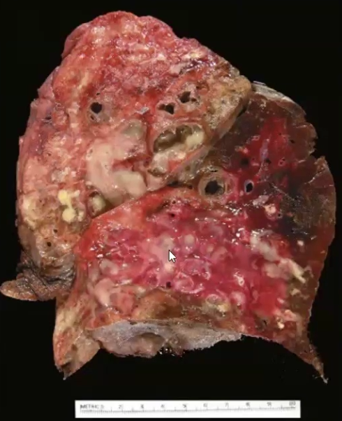 <ul><li><p>Defined as <strong>permanent dilation of the bronchi</strong> and bronchioles due to destruction of smooth muscle and elastic tissue</p></li><li><p>Caused by chronic necrotizing infections (<strong>Staph A. and Klebsiella</strong>)</p></li><li><p>Predisposing factors include bronchial obstruction, congenital conditions and <strong>necrotizing pneumonia (caused by Staph A. or Klebsiella!)</strong></p></li><li><p>Clinical Features: Chronic cough, purulent sputum, dyspnea, hemoptysis and recurrent respiratory tract infections</p></li></ul><p></p>