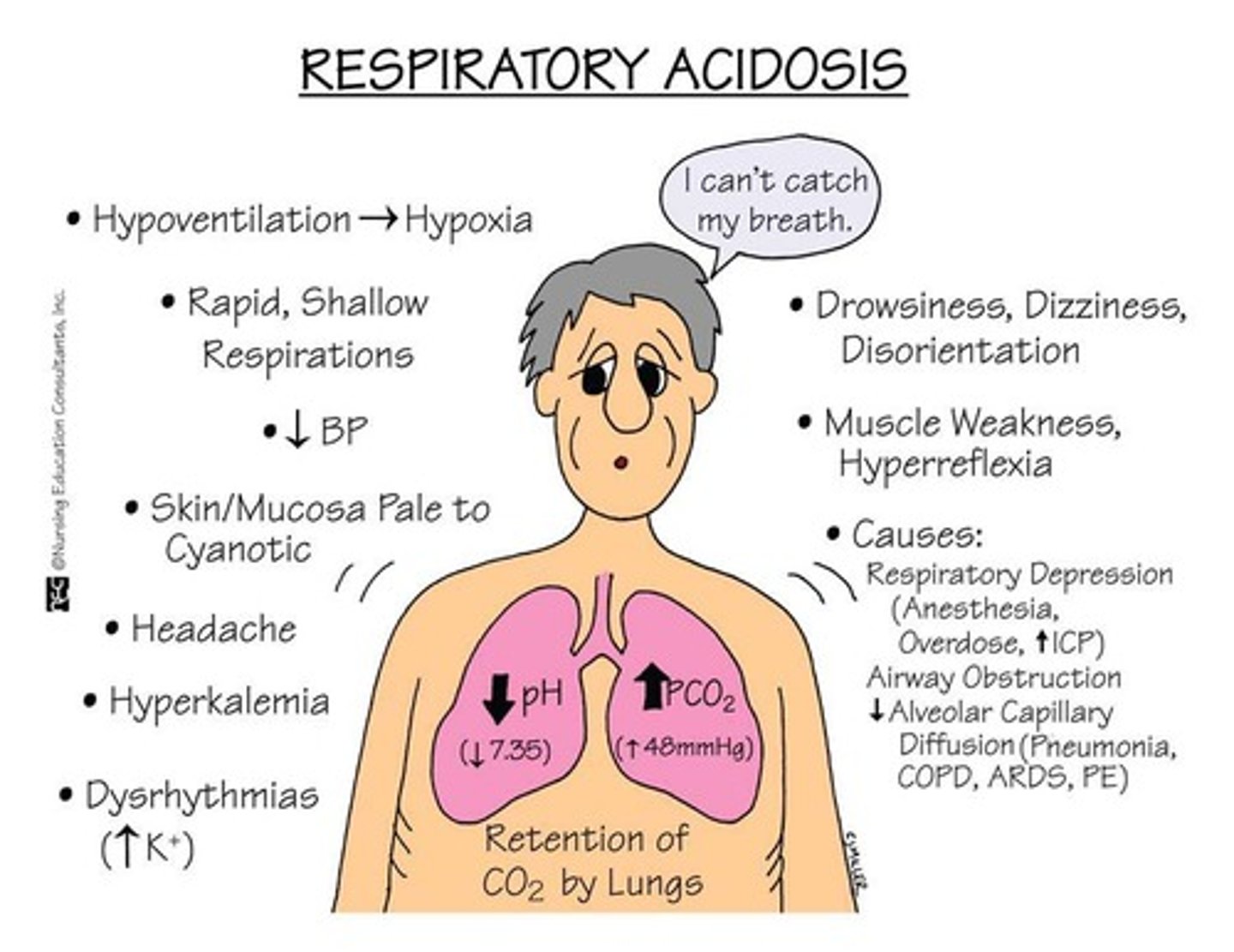 <p>Damage to the alveolar-capillary membrane causes widespread protein-rich alveolar infiltrates, leading to severe dyspnea.</p>