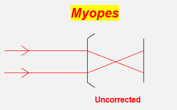 <p>myopic: with plus and minus </p>