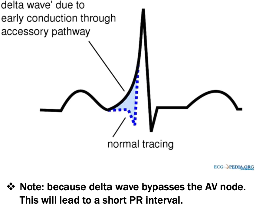 <p>slurring upstroke of QRS, diagnostic of WPW</p>