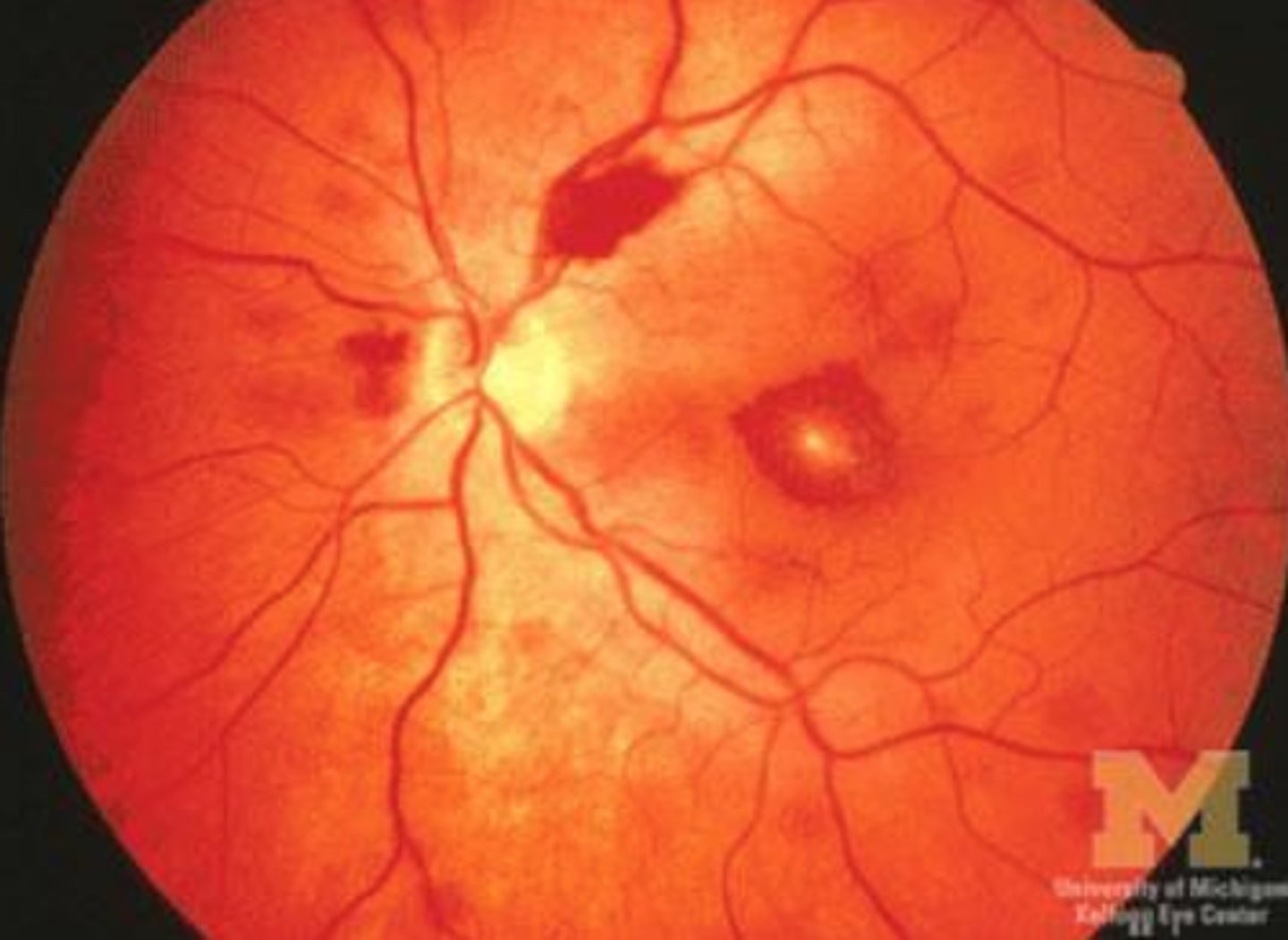 <p>Roth spots (bacterial endocarditis)</p>