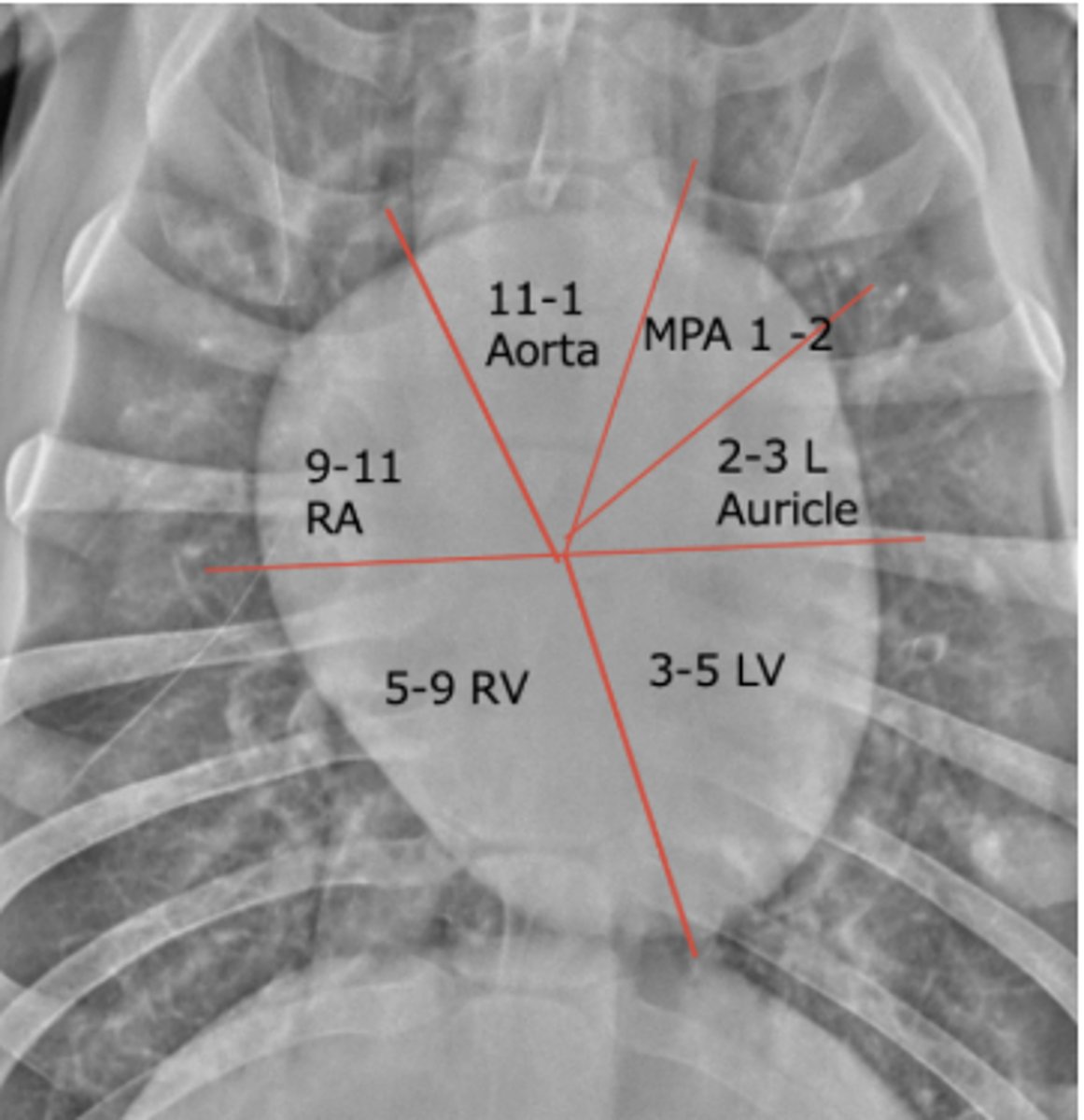 <p>Where is the left ventricle</p>