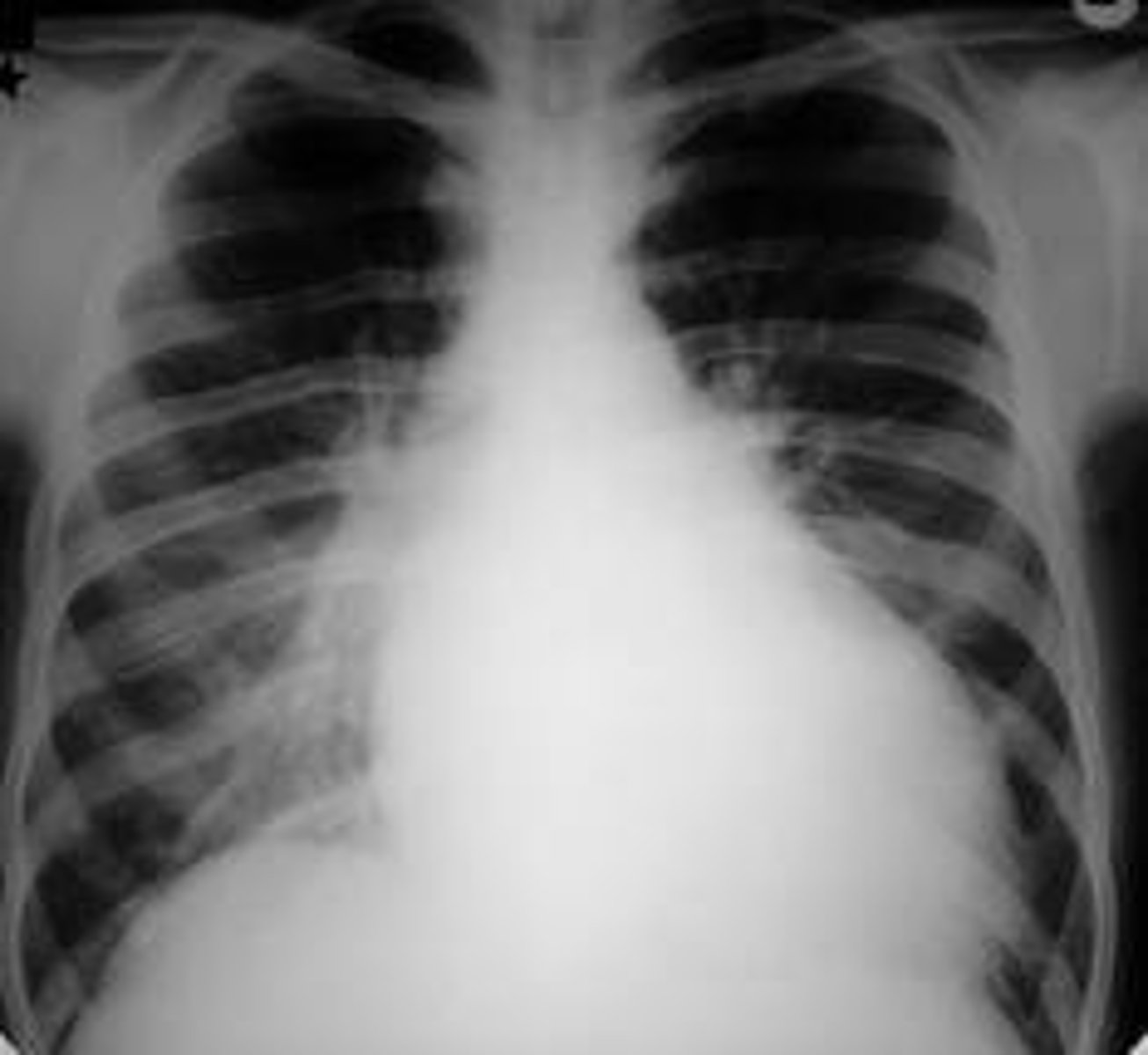 <p>Beck triad of cardiac tamponade</p><p>AND PULSUS PARADOXUS</p>
