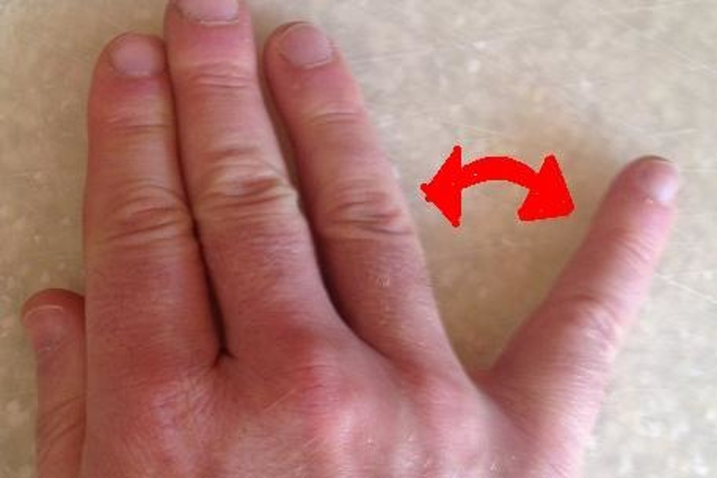<p>cannot adduct little finger back into neutral position</p>