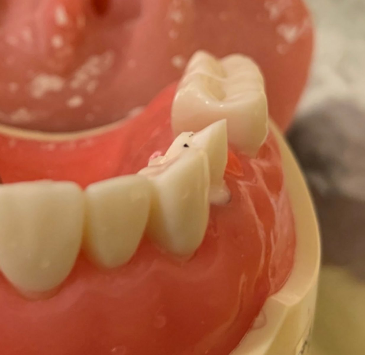 <p>What is wrong with the tooth prep on #5?</p>