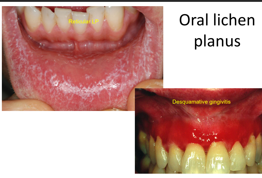 <p>Desquamative gingivitis may be caused by LP </p>