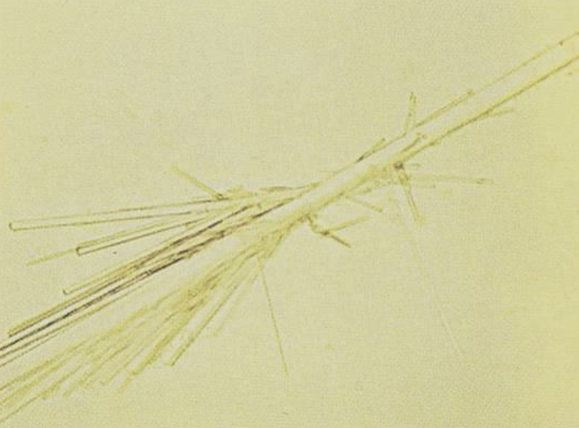 <p>What medication causes this crystal in urine?</p><p>Are these crystals found in acidic or alkaline urine?</p>