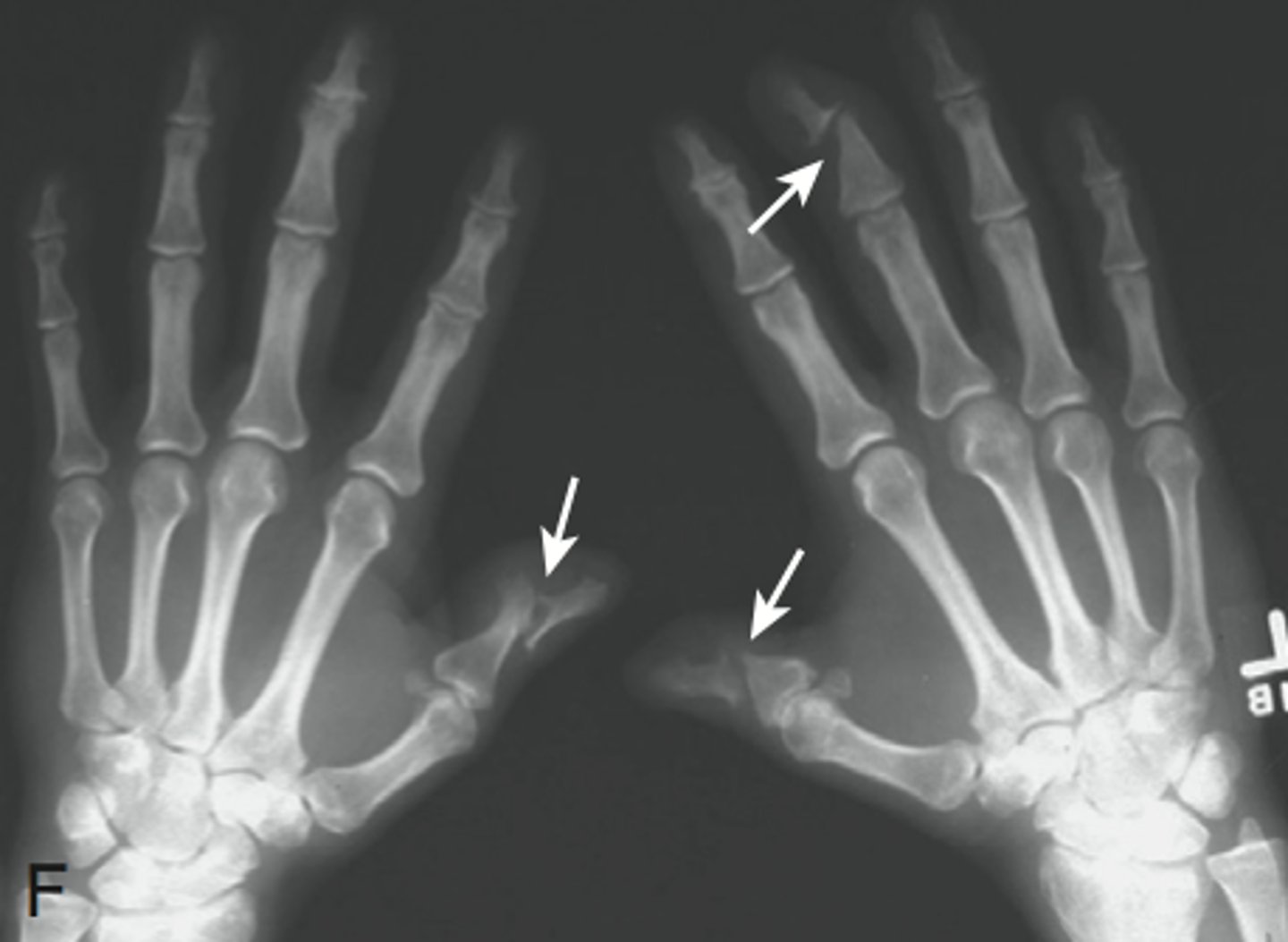 <p>Most common in psoriatic arthritis (PsA)</p><p>Erosion of DIP in pointed manner</p>