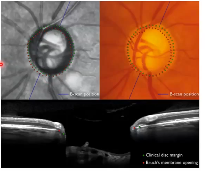 <p>bright line with red dot at end of it whih is the end of bruchs membrane </p><p>so everything inside that is part of the onh </p><p>has ideniftied minimum distance between red dot ( bruch membrane ending) and top of the nerve fibre layer </p><p>sometimes the subjective disc margin ( green dots) does not correspond to the actual opening in bruchs membrane (red dots); not in the same place as the red dots. mismatch</p><p></p>